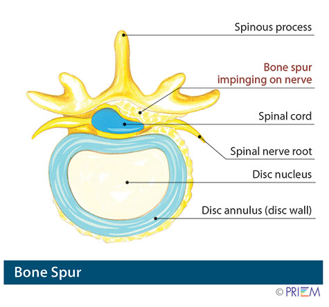 bone spur panama city