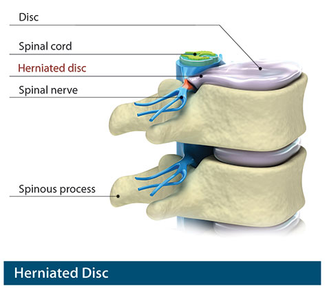 herniated disc Florida panhandle, Gulf coast, Florida, Panama City, Pensacola, Southwest Georgia, Southern Alabama, Mobile, Alabama