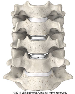 pain medicine Panama, Spine surgeon second opinion Panama City, Spine surgery second opinion Florida gulf coast, Second opinion for neck surgery Panama City, Spine surgeon Panama City, Spine surgeon Dothan, Laser spine surgery Florida Gulf Coast, Minimally invasive spine surgery Florida Panhandle, Home remedies for back pain Florida, Home remedies for back pain Panama City, Home remedy back pain Pensacola, Herniated disc Panhandle Florida, Non-surgical treatment options for back pain Florida, Artificial disc replacement neck Florida, physical therapy Panama