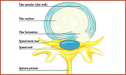 herniated disc