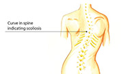 degenerative disc